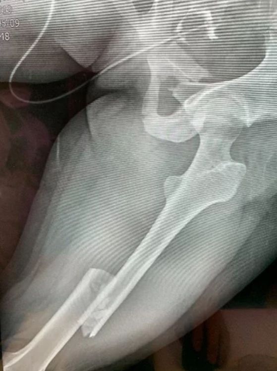 從X光片下發現，吳女骨盆嚴重骨折，會陰部撕裂傷。民眾提供