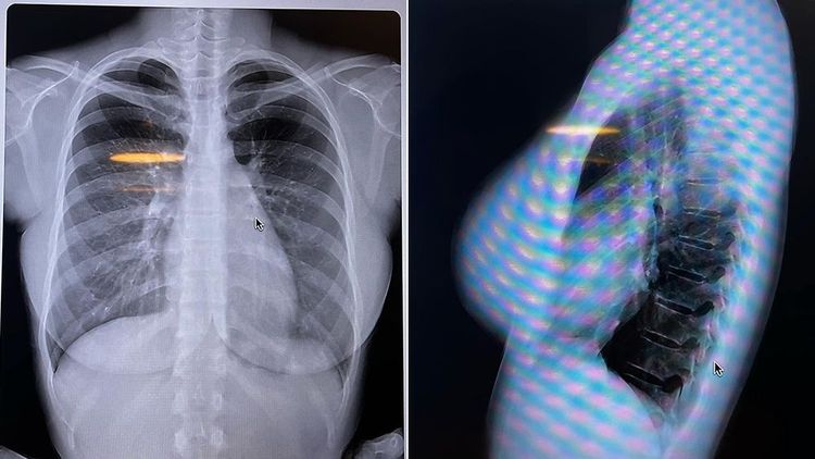 鈴木富美奈公布胸部X光照片。翻攝自鈴木富美奈推特