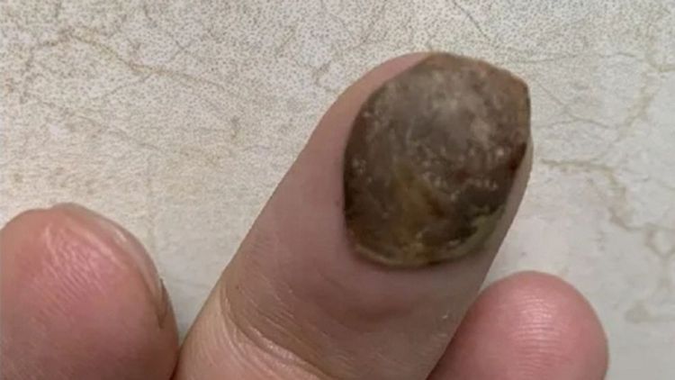 結果所謂「腫瘤」只是蓮子殼。翻攝自微博