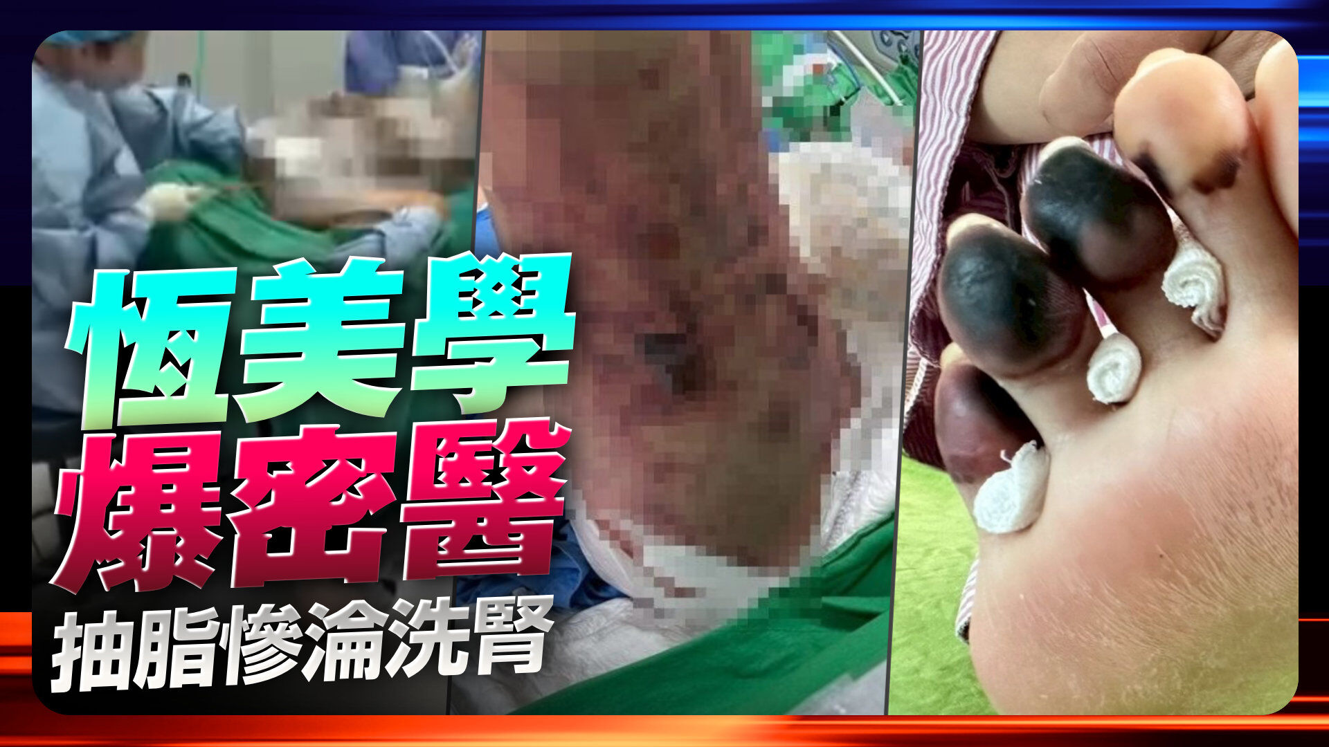 恆美學爆密醫 抽脂慘淪洗腎