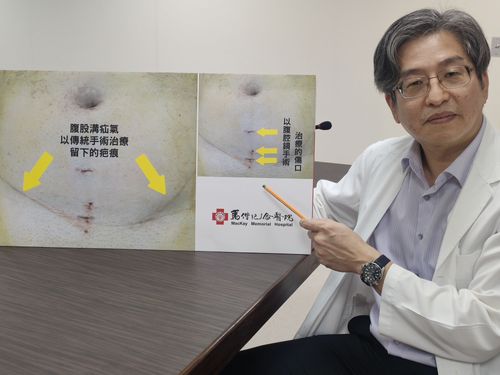 長期便祕、咳嗽易疝氣　老翁屢復發靠3小洞甩陰霾