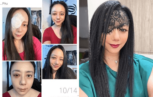 高慧君勇曬素顏血眼照　苦戰病魔1年「珍惜重新得見的美好」