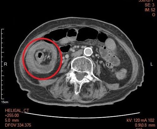 8旬嬤腹痛、貧血3個月未就醫　大腸鏡檢查發現竟已罹癌