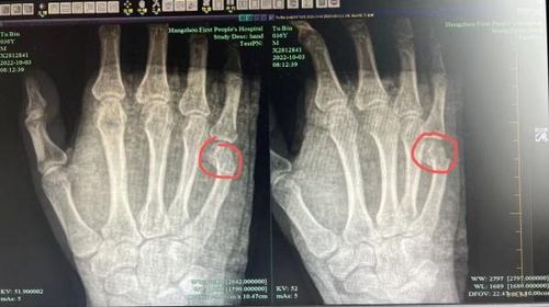 中國爸輔導兒作業　氣到捶桌「啪」一聲！竟把自己打進醫院