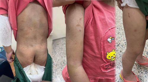 香菸燙、肋骨斷、背瘀青 屏東虐童畫面曝!爸嗆媽媽同居人踹共