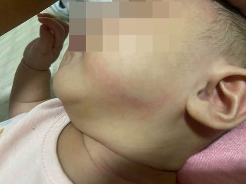 澎湖惡劣保母!5月大女嬰被捏出滿身瘀青 求饒再犯「下場慘了」