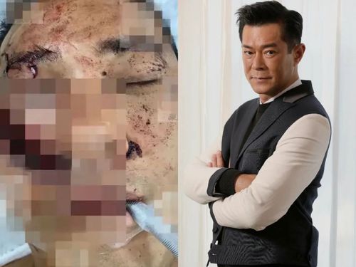 「翻版古天樂」遇襲臉皮脫落毀容縫百針 古天樂本尊暖送20萬救急