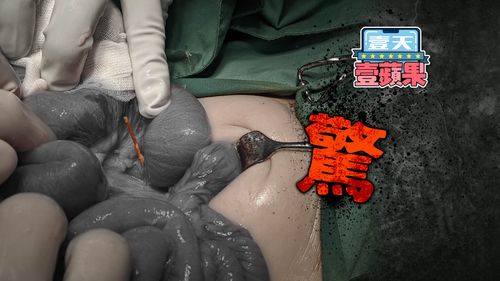 獨家｜1歲娃公園返家高燒嘔吐　剖腹驚見「腸插這根」