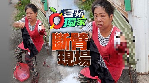 獨家|奮鬥廿年終破30K 她卻遇工安斷臂「只求度日但好難」