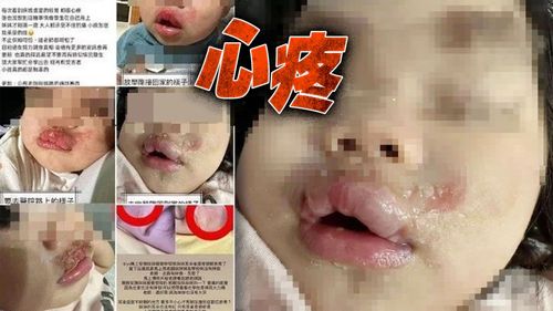 70度高溫奶強灌!1歲娃香腸嘴2度燙傷 高雄托嬰中心涉虐童