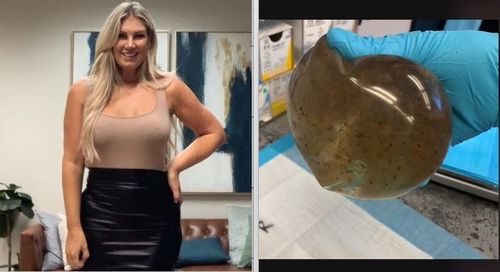 超噁!她怪病纏身10年 致病的隆乳鹽水袋竟長這樣