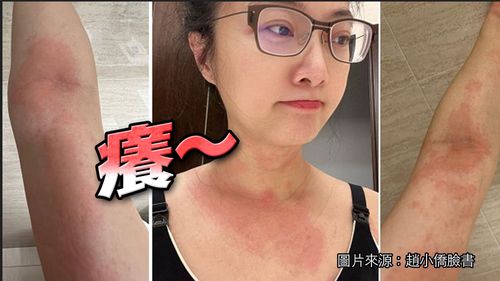 趙小僑半夜PO身體特寫照　「全身奇癢+發燙」惹人心疼