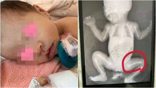 獨家｜台中新生女嬰住院離奇腿骨折！家長見X光心碎　怒告林新醫院