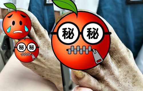 慎入!這張照片叫孤獨 醫師曝「殭屍指甲」悲歌