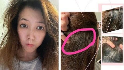 廖家儀車禍滿月後腦勺突冒一症狀 「我很害怕」半夜求救厲害醫生