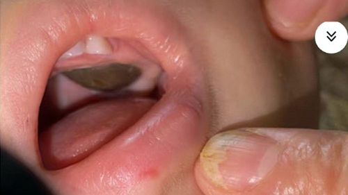 權威級庸醫!判定11月幼童口腔腫瘤須全麻手術 棉花棒一戳大逆轉