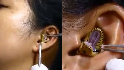 驚悚影片｜女子耳朵冒出張牙蛇頭　醫師狂夾搞不定