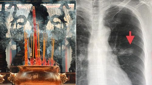 燒香6年每周20根　她不抽菸也沒二手菸仍罹肺癌